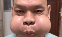 广东一男子吹玻璃30年致腮帮变形，调侃自己是“青蛙王子”会蛤蟆功