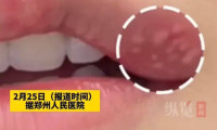 嘴角疱疹未及时处理引发脑死亡，医师紧急提示：发热头痛并伴有唇部疱疹需尽快就诊